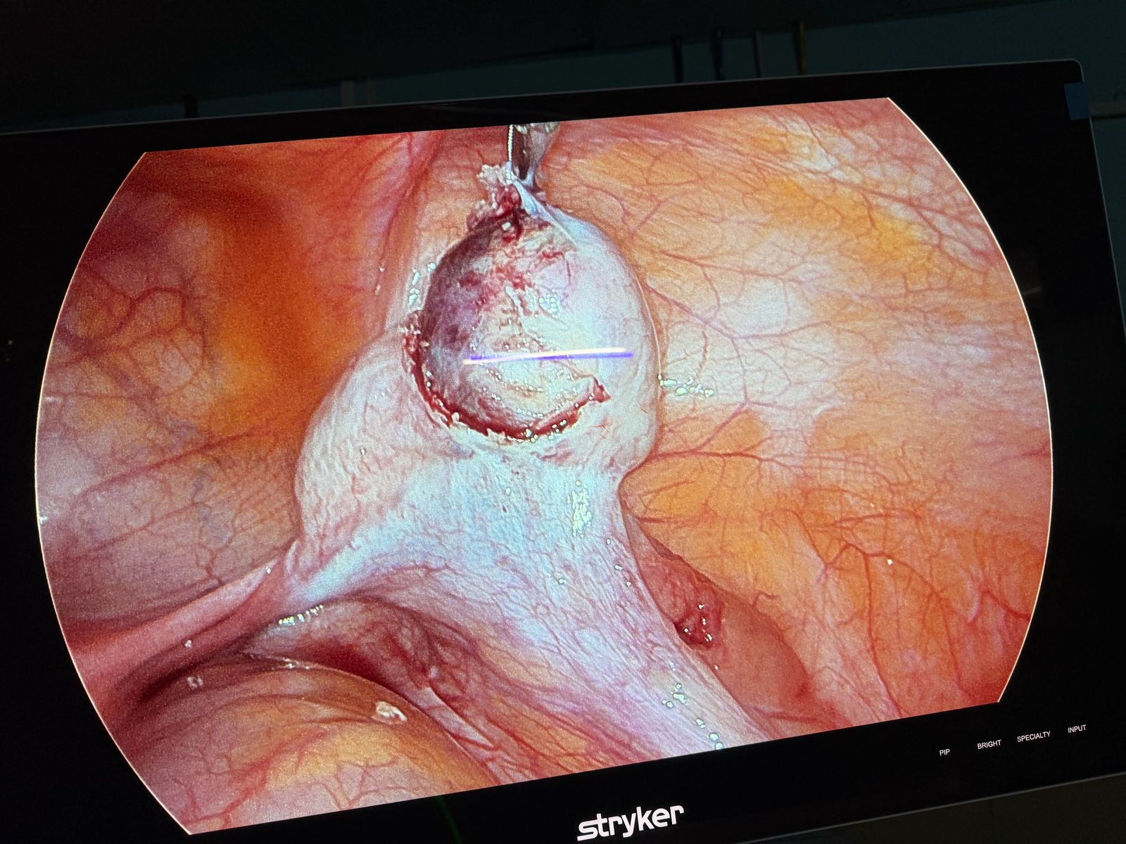 Dr. Mariam Anjum — Laparoscopic View — Intraoperative